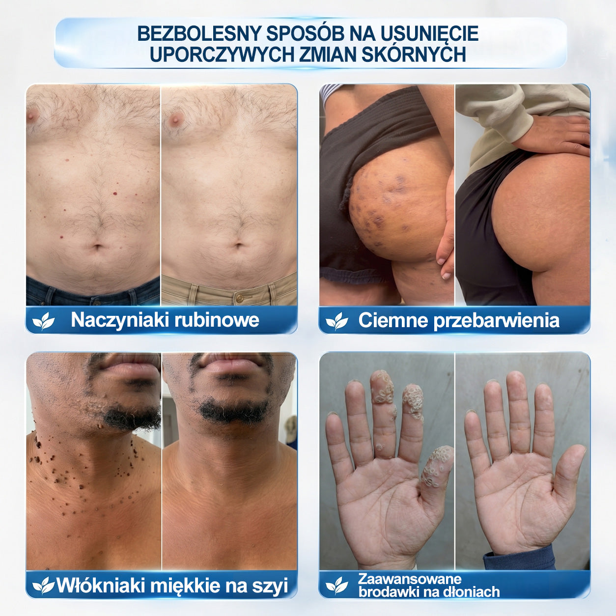 🏥🛒 𝐏i𝐜𝐝o® 7 𝑫𝒏𝒊 𝑷𝒓𝒆𝒑𝒂𝒓𝒂𝒕 𝑫𝒐 𝑼𝒔𝒖𝒘𝒂𝒏𝒊𝒂 𝑾łó𝒌𝒏𝒊𝒂𝒌ó𝒘 𝑴𝒊ę𝒌𝒌𝒊𝒄𝒉 𝑰 𝑷𝒓𝒛𝒆𝒃𝒂𝒓𝒘𝒊𝒆ń(𝐁𝐞𝐳 𝐁ó𝐥𝐮, 𝐁𝐞𝐳 𝐁𝐥𝐢𝐳𝐧 – 𝐑𝐨𝐥𝐥-𝐨𝐧)